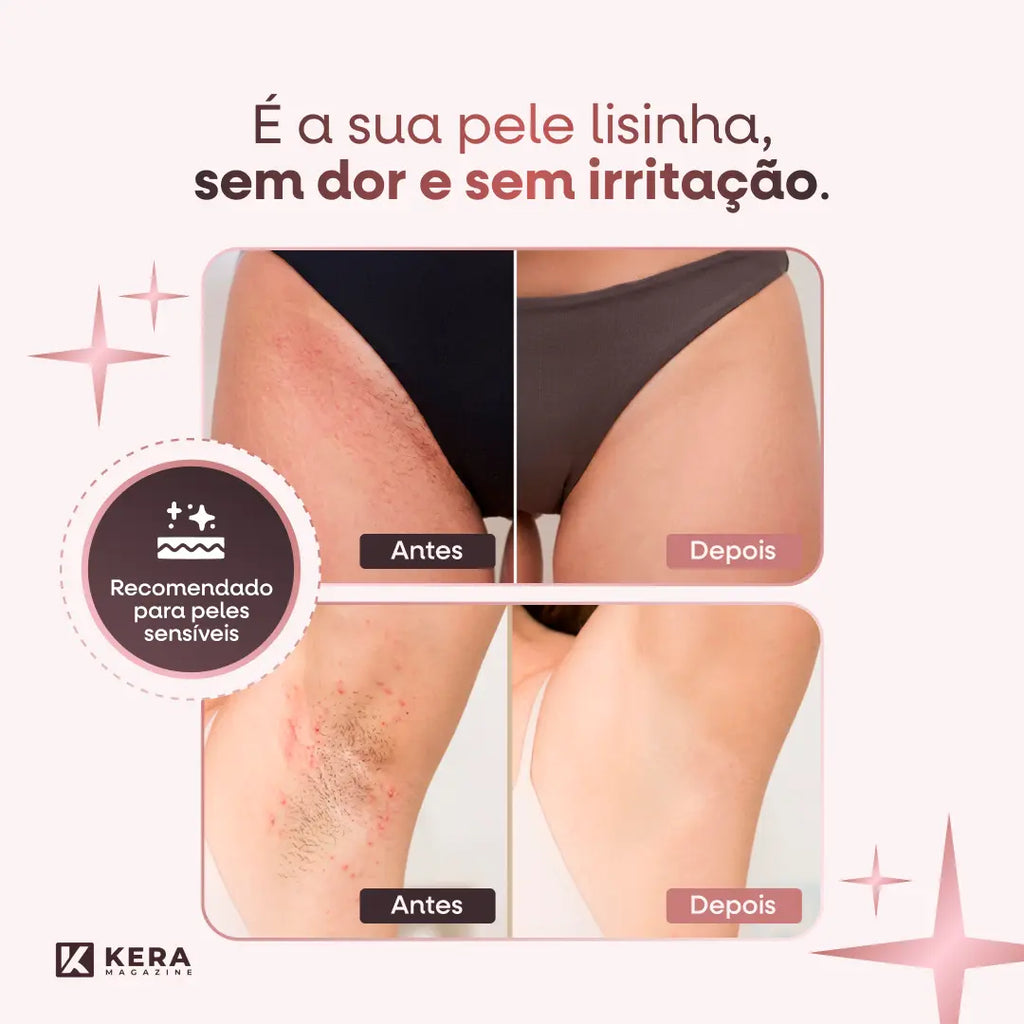 DermaSkin® - Depilador Elétrico 4 em 1 (Pele Lisa e Sem Irritações) - Frete Grátis!